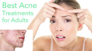 Adult acne